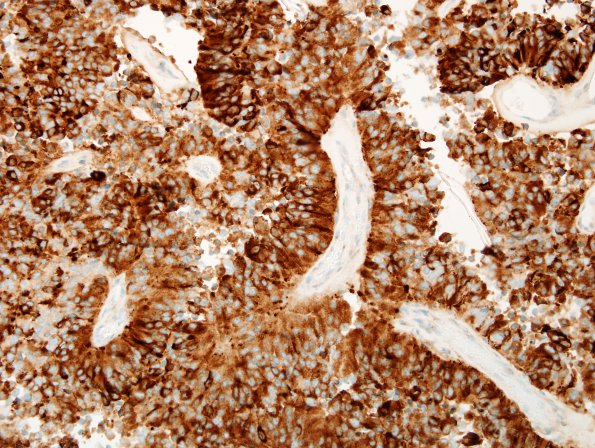 7D Papillary Tumor Pineal Region (PTPR, Case 7) SYN 3.jpg