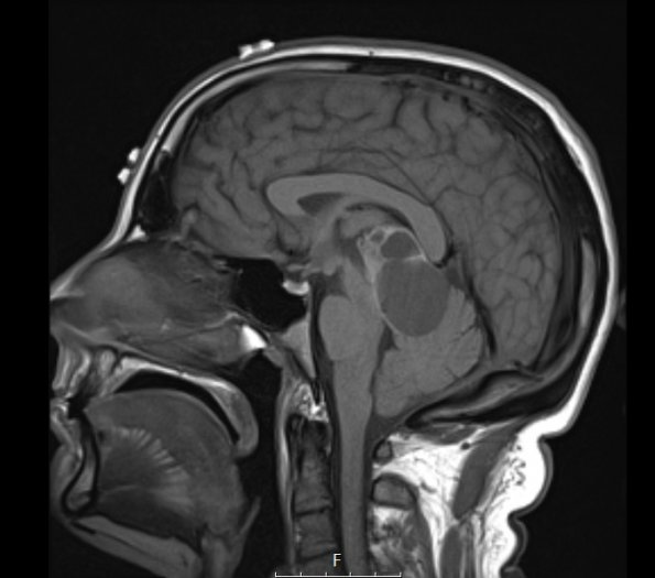 8A1 Papillary Tumor Pineal Region (Case 8) T1noC sag A - Copy