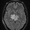 8A3 Papillary Tumor Pineal Region (Case 8) FLAIR axial A - Copy