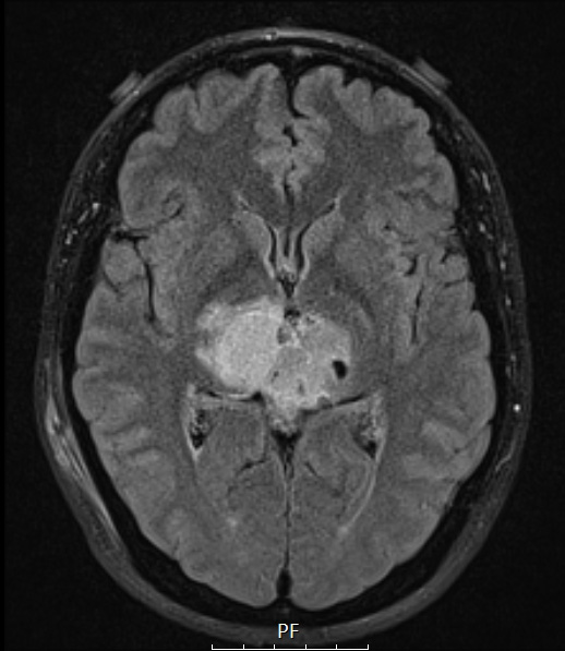 8A3 Papillary Tumor Pineal Region (Case 8) FLAIR axial A - Copy