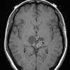 8A4 Papillary Tumor Pineal Region (Case 8) T1noC axial A - Copy