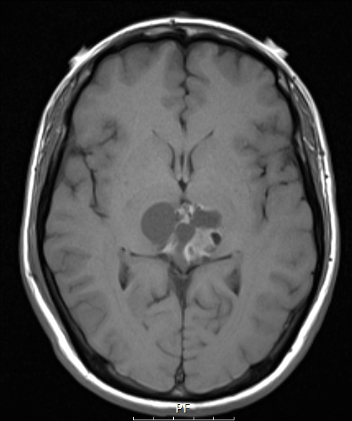 8A4 Papillary Tumor Pineal Region (Case 8) T1noC axial A - Copy