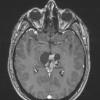 8A5 Papillary Tumor Pineal Region (Case 8) T1W axial - Copy