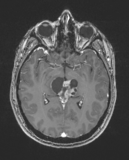 8A5 Papillary Tumor Pineal Region (Case 8) T1W axial - Copy