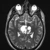 8A6 Papillary Tumor Pineal Region (Case 8) T2W axial A - Copy