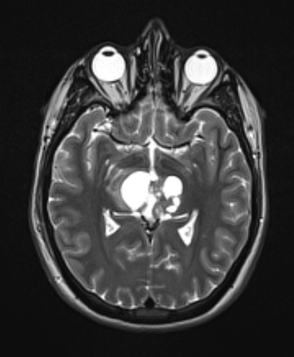 8A6 Papillary Tumor Pineal Region (Case 8) T2W axial A - Copy