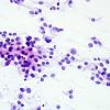 8B1 Papillary Tumor Pineal Region (Case 8) H&E smear.jpg