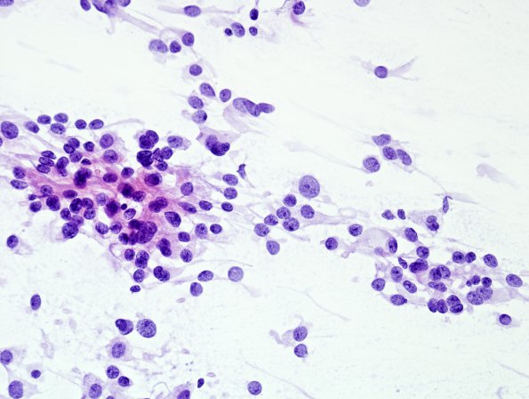 8B1 Papillary Tumor Pineal Region (Case 8) H&E smear.jpg