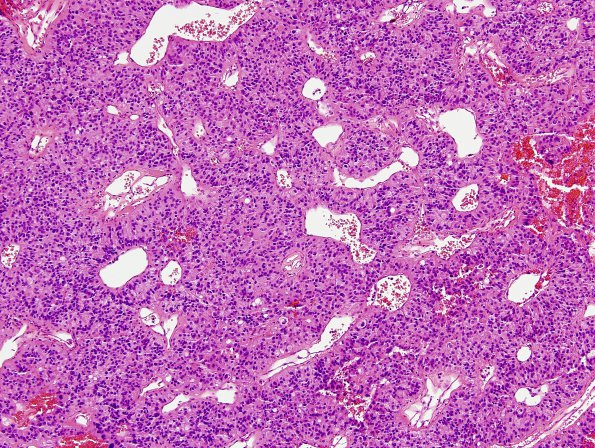 8B10 Papillary Tumor Pineal Region (Case 8) series 2 H&E 4.jpg