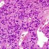 8B11 Papillary Tumor Pineal Region (Case 8) series 2 H&E 6.jpg