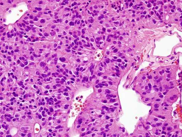 8B11 Papillary Tumor Pineal Region (Case 8) series 2 H&E 6.jpg