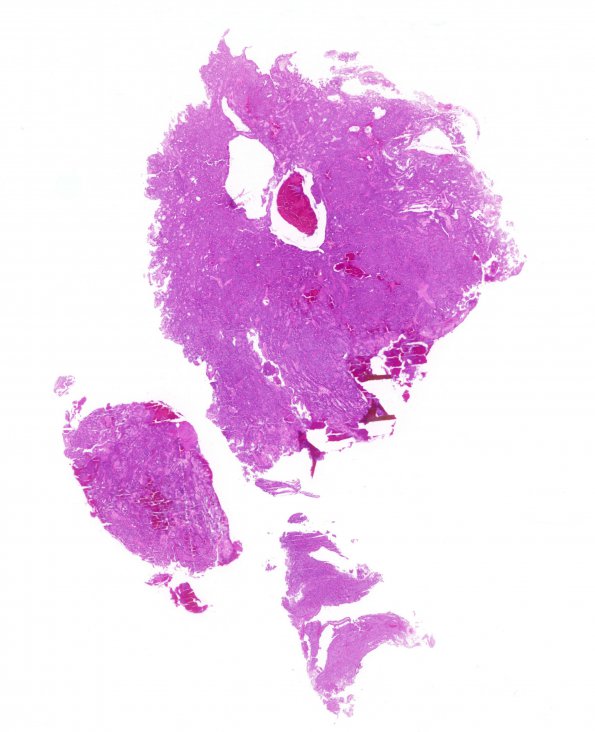 8B2 Papillary Tumor Pineal Region (Case 8) 1 H&E WM