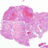 8B3 Papillary Tumor Pineal Region (Case 8) H&E 1 (2)