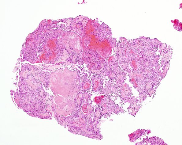 8B3 Papillary Tumor Pineal Region (Case 8) H&E 1 (2)