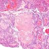 8B4 Papillary Tumor Pineal Region (Case 8) H&E 9