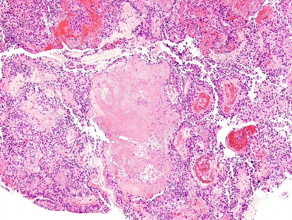 8B4 Papillary Tumor Pineal Region (Case 8) H&E 9