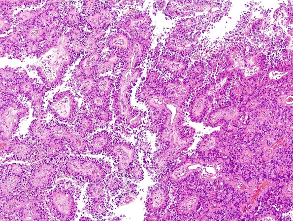 8B5 Papillary Tumor Pineal Region (Case 8) H&E 4.jpg