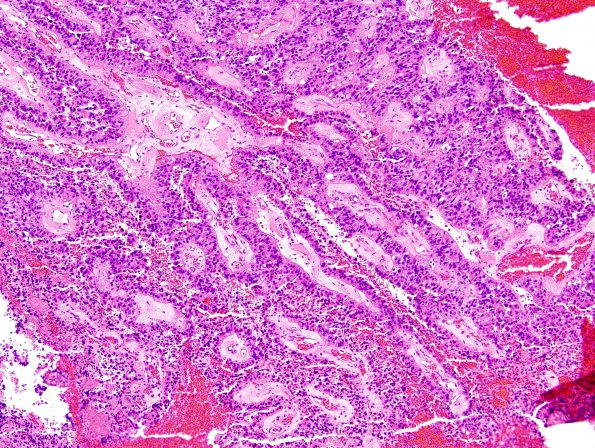 8B6 Papillary Tumor Pineal Region (Case 8) H&E 3 (2)