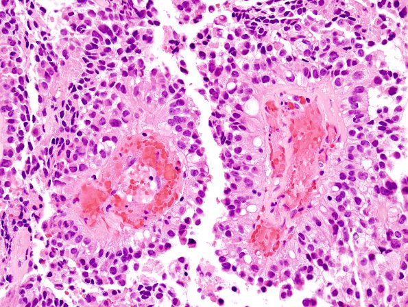 8B7 Papillary Tumor Pineal Region (Case 8) H&E 6 (2)