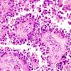 8B8 Papillary Tumor Pineal Region (Case 8) H&E 7.jpg