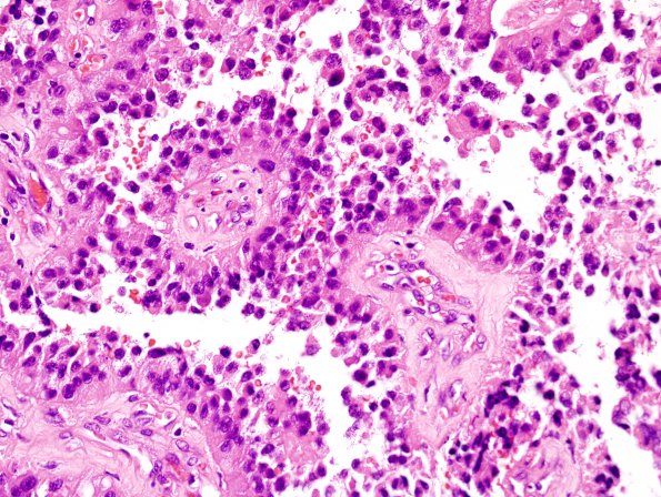 8B8 Papillary Tumor Pineal Region (Case 8) H&E 7.jpg