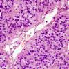 8B9 Papillary Tumor Pineal Region (Case 8) H&E 10.jpg