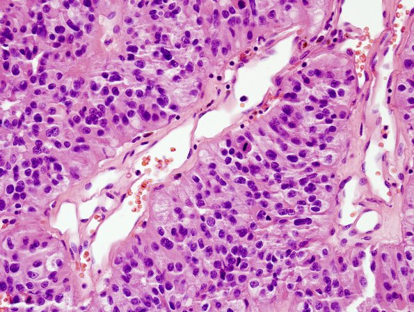 8B9 Papillary Tumor Pineal Region (Case 8) H&E 10.jpg