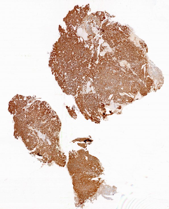 8C1 Papillary Tumor Pineal Region (Case 8) 1 CK8-18 WM