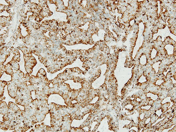 8C2 Papillary Tumor Pineal Region (Case 8) CK8-18 2