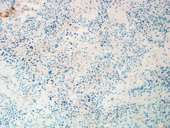 8E1 Papillary Tumor Pineal Region (Case 8) NF 1.jpg