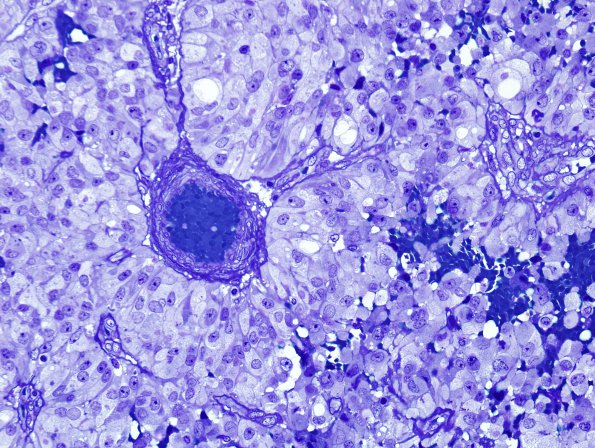 8F2 Papillary Tumor Pineal Region (Case 8) Plastic 3