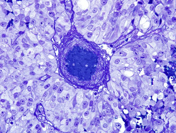 8F3 Papillary Tumor Pineal Region (Case 8) Plastic 2