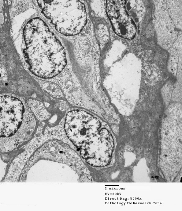 8G1 Papillary Tumor Pineal Region (Case 8) EM 002 - Copy