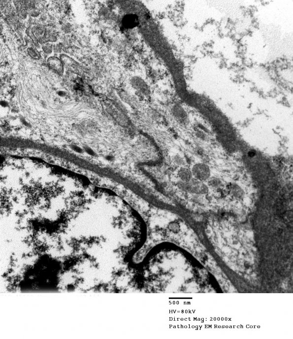 8G2 Papillary Tumor Pineal Region (Case 8) EM 003 - Copy