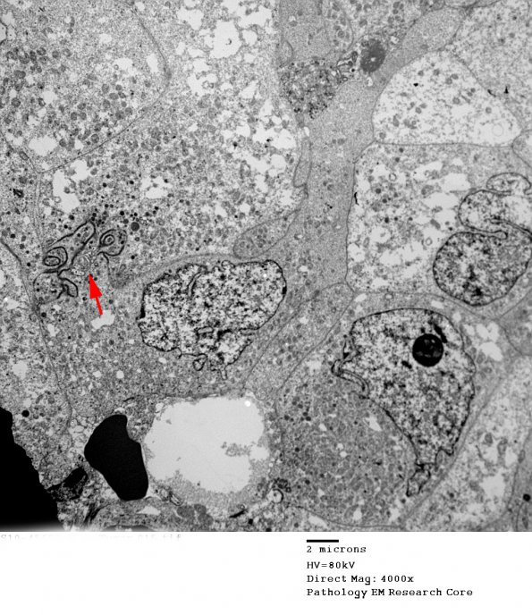 8G3 Papillary Tumor Pineal Region (Case 8) EM 015 copy - Copy