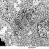 8G4 Papillary Tumor Pineal Region (Case 8) EM 016 - Copy