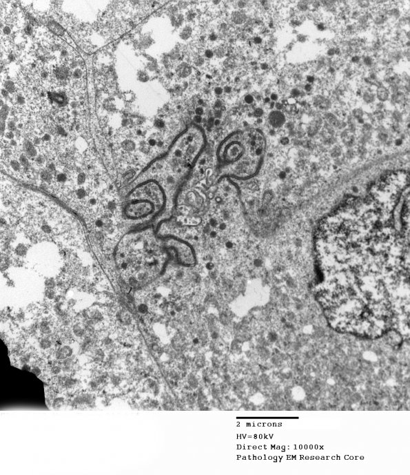 8G4 Papillary Tumor Pineal Region (Case 8) EM 016 - Copy