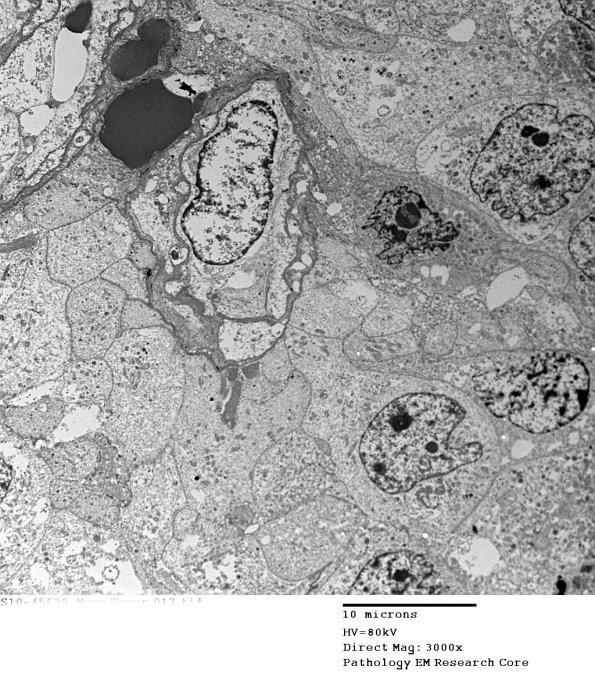 8G5 Papillary Tumor Pineal Region (Case 8) EM 017 - Copy