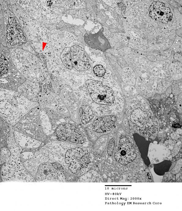 8G6 Papillary Tumor Pineal Region (Case 8) EM 024 copy - Copy