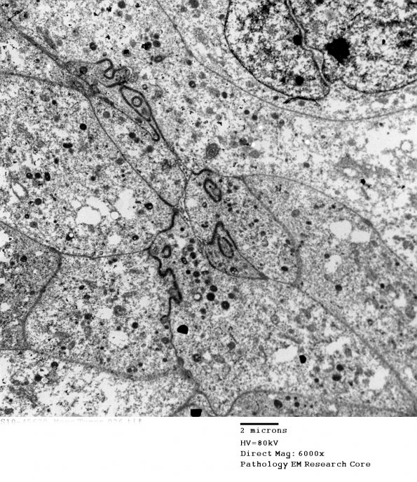 8G7 Papillary Tumor Pineal Region (Case 8) EM 026 - Copy