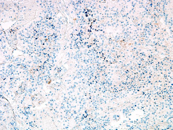 8H Papillary Tumor Pineal Region (Case 8) SYN 1