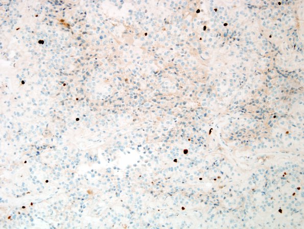 8I1 Papillary Tumor Pineal Region (Case 8) Ki67.jpg