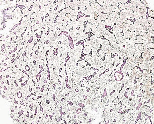 8J Papillary Tumor Pineal Region (Case 8) Retic 3.jpg