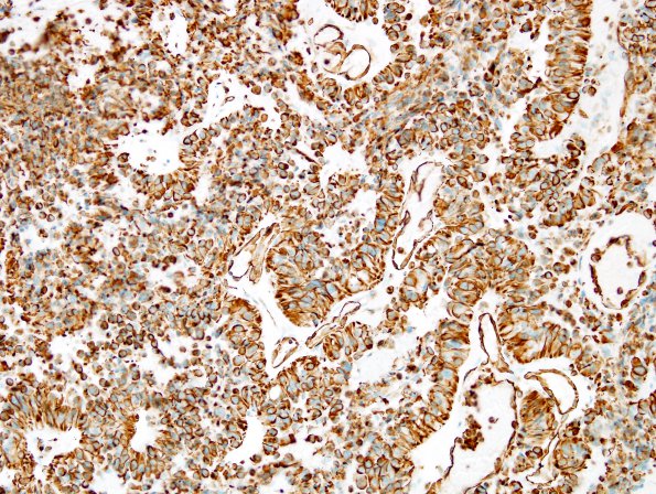 8L Papillary Tumor Pineal Region (Case 8) VIM 3