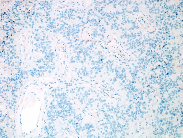 8M Papillary Tumor Pineal Region (Case 8) EMA