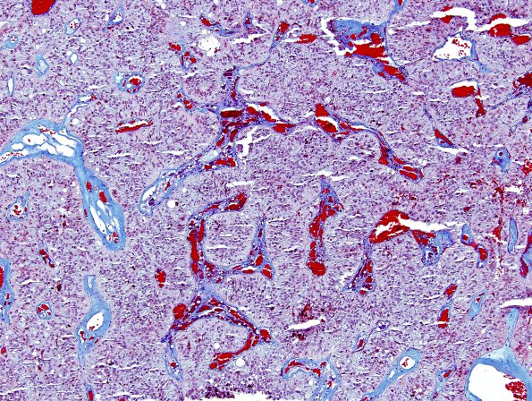 8N1 Papillary Tumor Pineal Region (Case 8) Trichrome