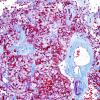 8N2 Papillary Tumor Pineal Region (Case 8) series Trichrome 6.jpg