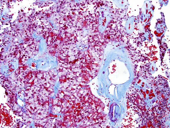 8N2 Papillary Tumor Pineal Region (Case 8) series Trichrome 6.jpg