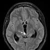 9A1 Papillary Tumor Pineal Region (Case 9) FLAIR axial A copy - Copy