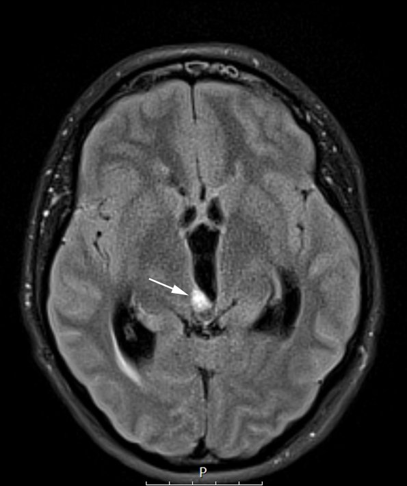 9A1 Papillary Tumor Pineal Region (Case 9) FLAIR axial A copy - Copy